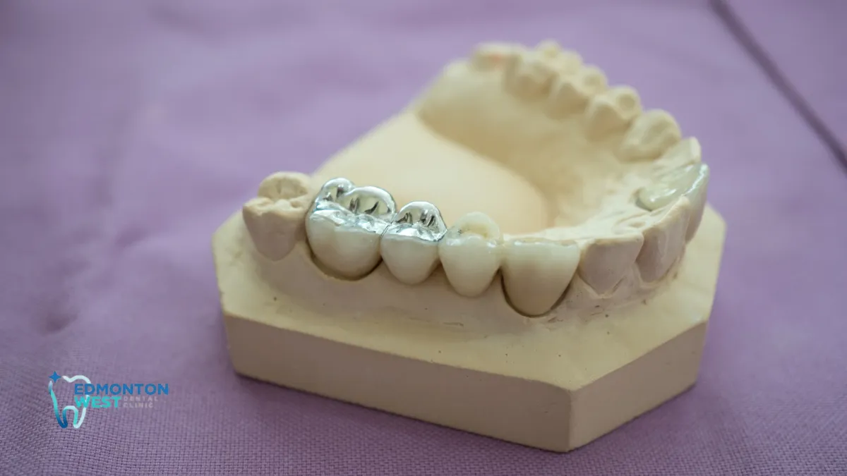 How to Care for Composite vs. Amalgam Fillings